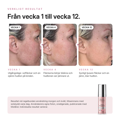 Anti-Pigment Dual Serum, verkligt resultat, användarens egna foton