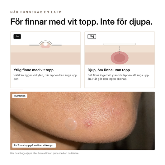 Hydrokolloid Aknelappar, fördelar